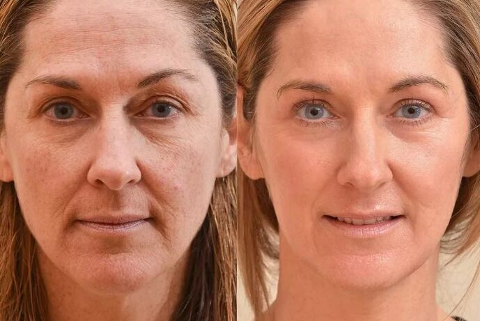 Rejuvenation of the face before and after