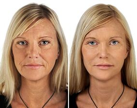 before and after