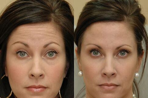 Botulinum toxin injections are suitable for use in any area of ​​the face