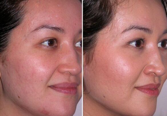 microdermabrasion course