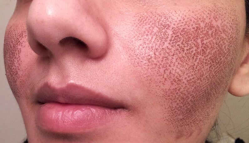 skin after fractional laser rejuvenation