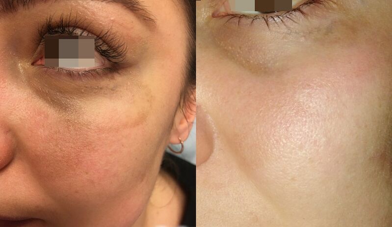 skin before and after fractional laser rejuvenation