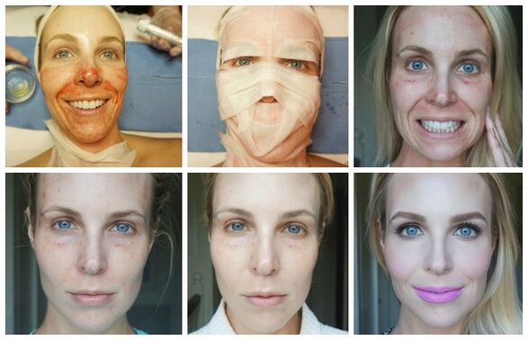 Stages of facial skin healing after successful plasma lifting