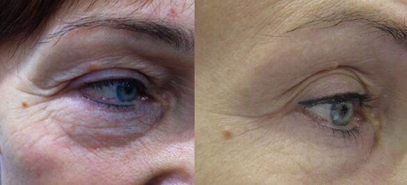 The result of effective plasma rejuvenation of the area around the eyes